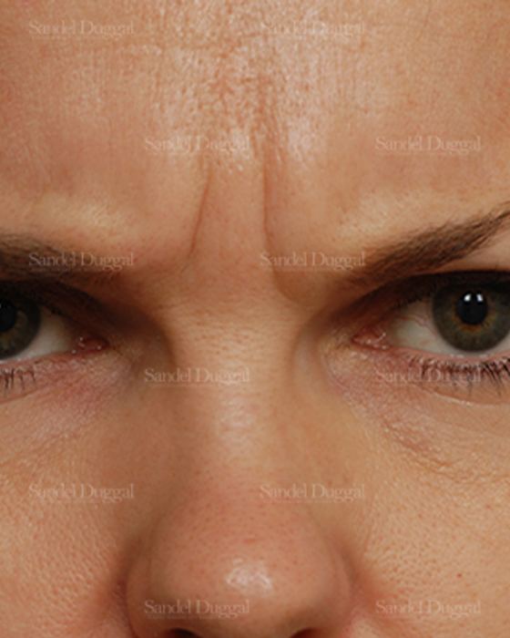 Botox & Fillers before, case 842