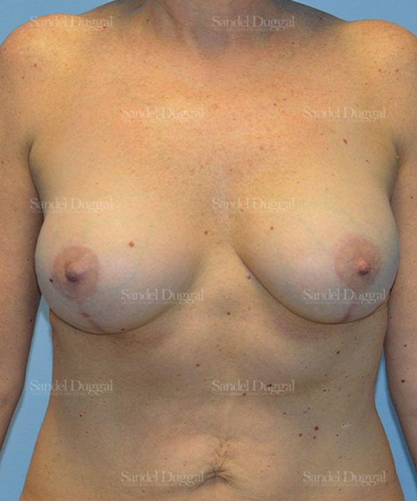 Breast Augmentation with Lift after, case 3414