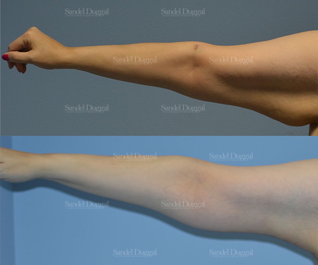 Brachioplasty before and after, case 2134
