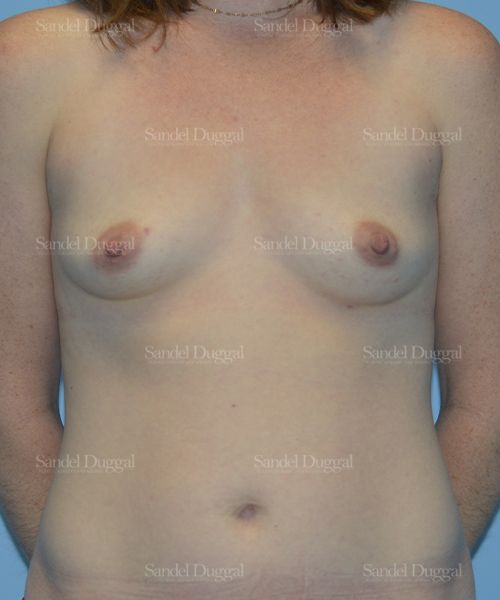 Breast Augmentation before, case 3073