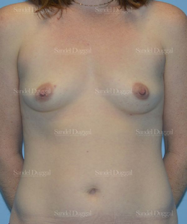 Breast Augmentation before, case 3073