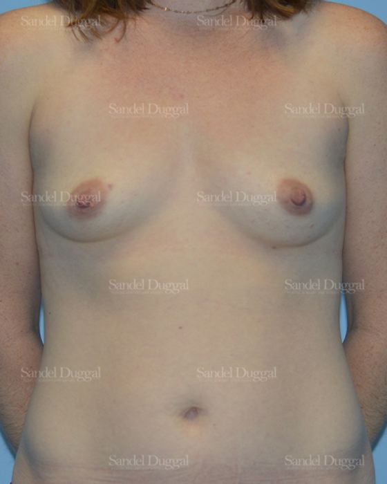 Breast Augmentation before, case 3073