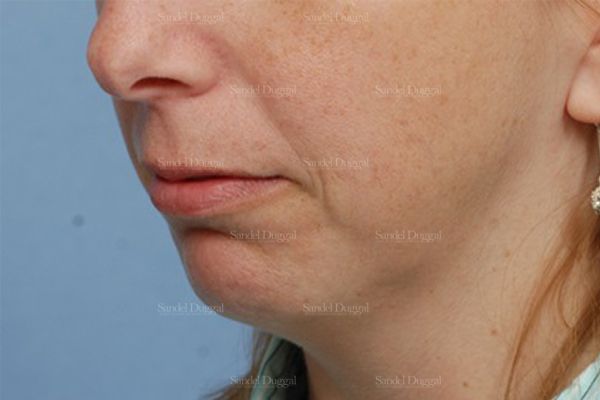 Chin Augmentation before, case 1474