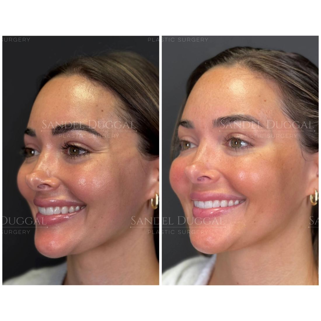 Botox & Fillers before and after, case 6007
