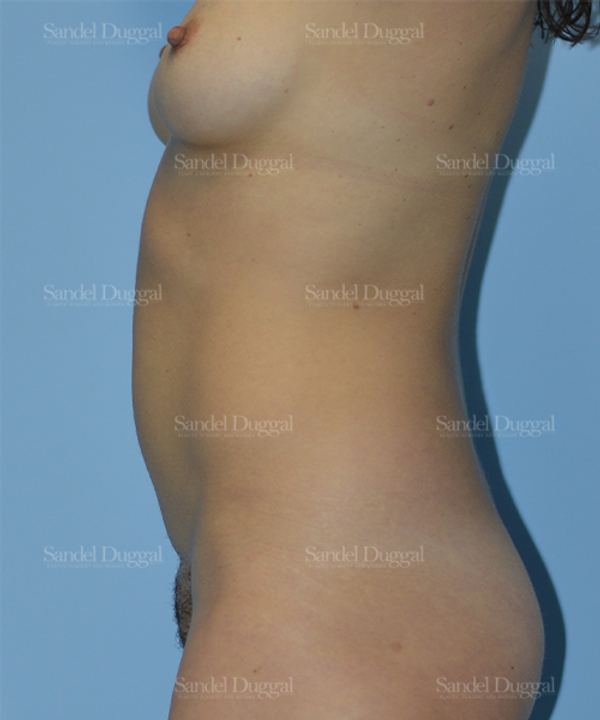 Tummy Tuck before, case 1608