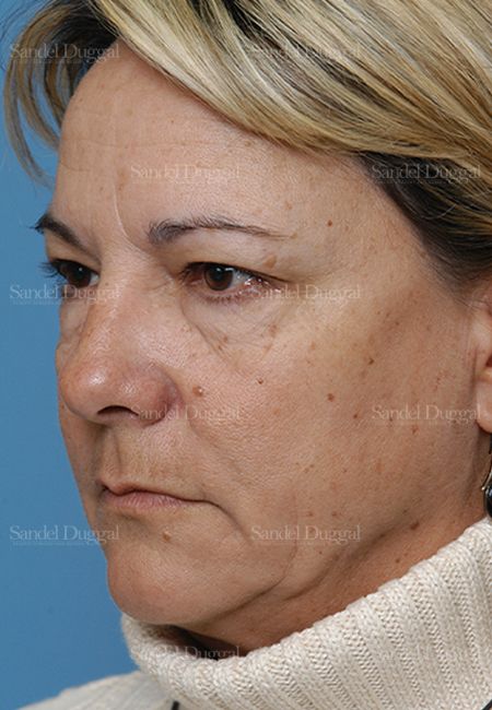 Laser Skin Resurfacing before, case 2935