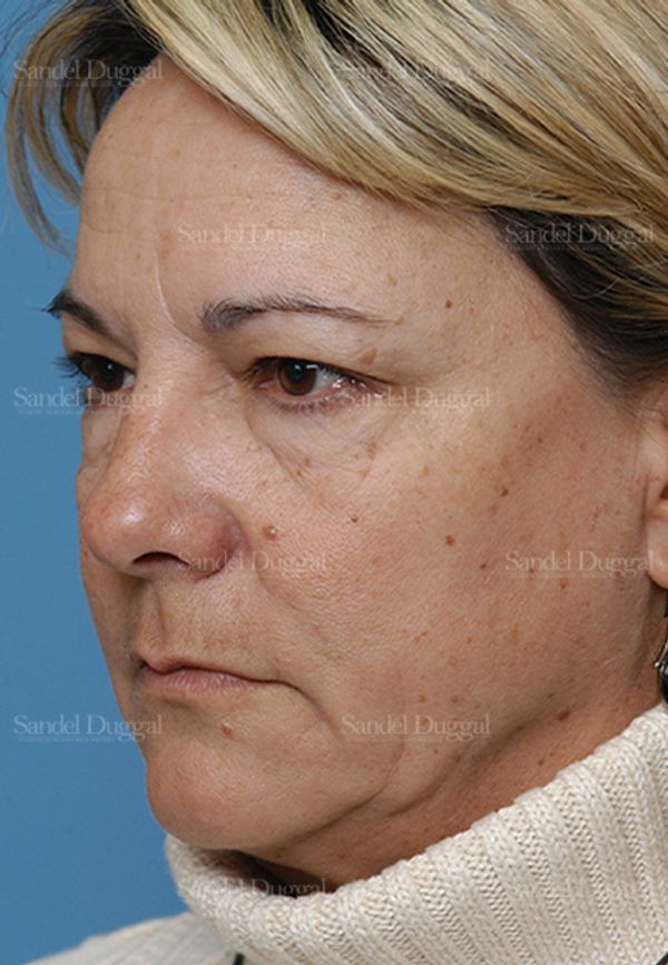 Laser Skin Resurfacing before, case 2935