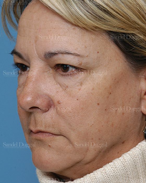 Laser Skin Resurfacing before, case 2935