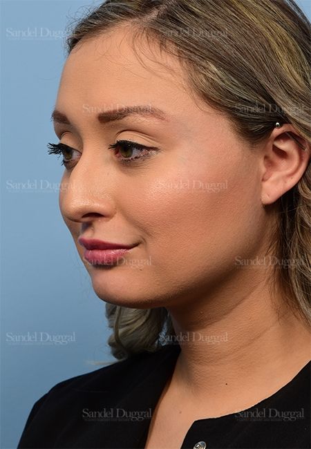 Non-Surgical Rhinoplasty before, case 5369
