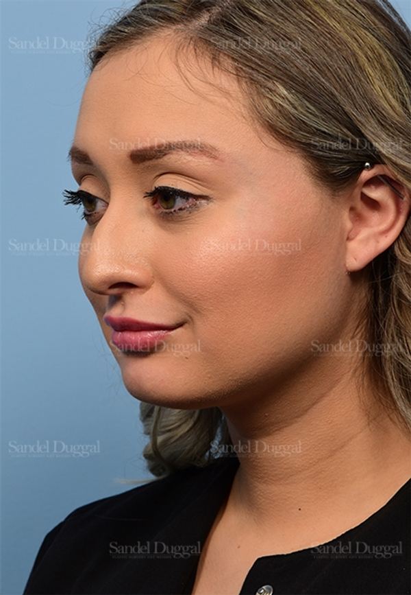 Non-Surgical Rhinoplasty before, case 5369