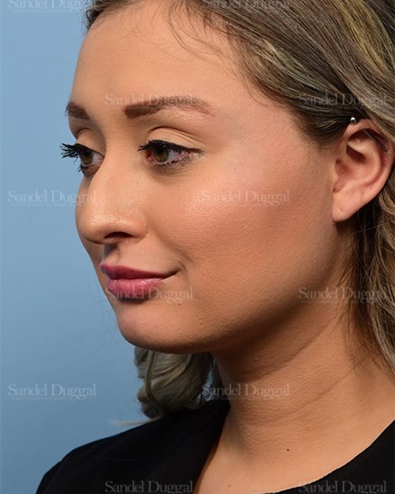 Non-Surgical Rhinoplasty before, case 5369