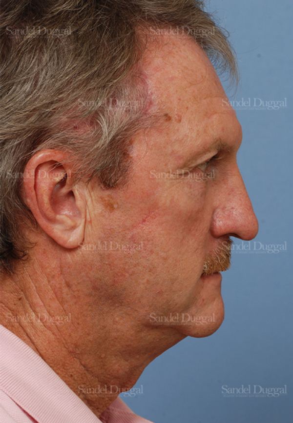 Reconstruction after Mohs after, case 2751
