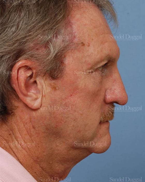 Reconstruction after Mohs after, case 2751