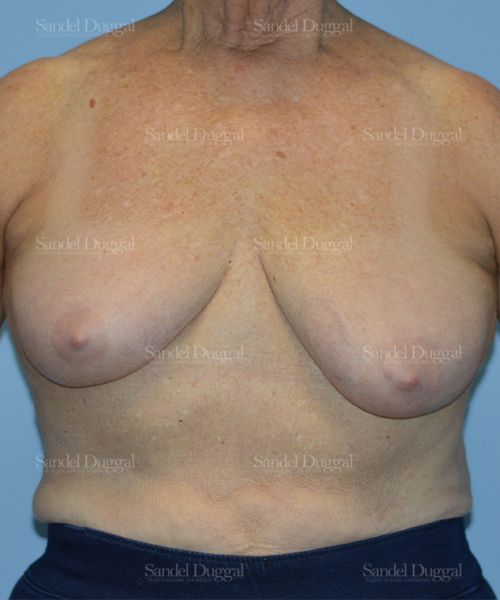 Breast Lift before, case 3315