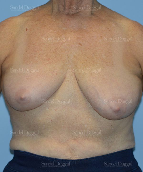 Breast Lift before, case 3315