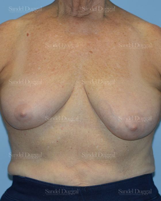 Breast Lift before, case 3315