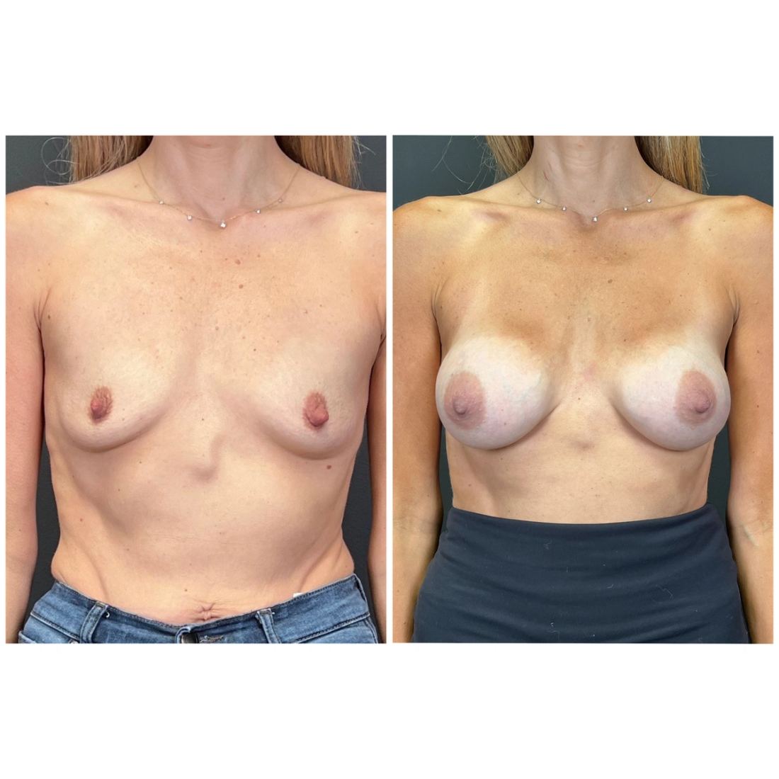 Motiva Preserve before and after, case preserve-05