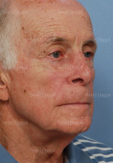 Reconstruction after Mohs after, case 2808