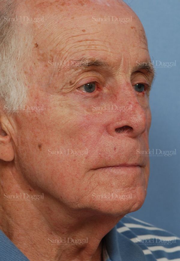 Reconstruction after Mohs after, case 2808