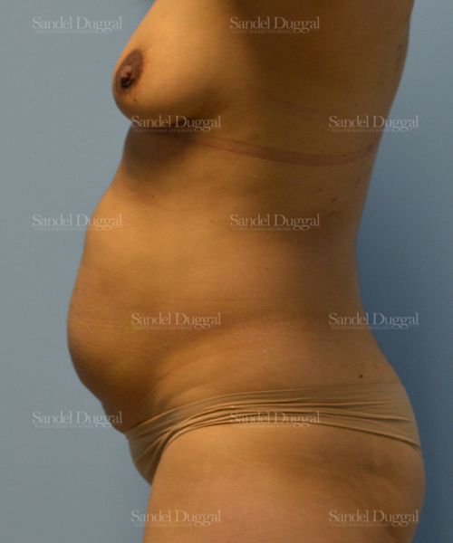 Tummy Tuck before, case 1580