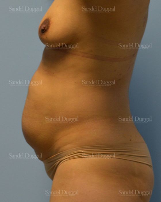 Tummy Tuck before, case 1580