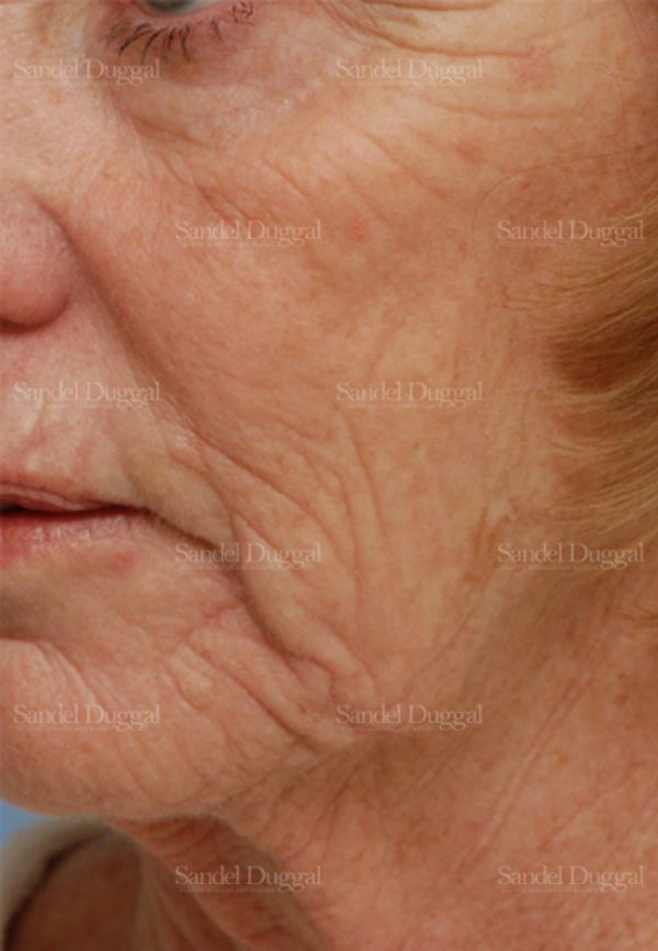Laser Skin Resurfacing before, case 2941
