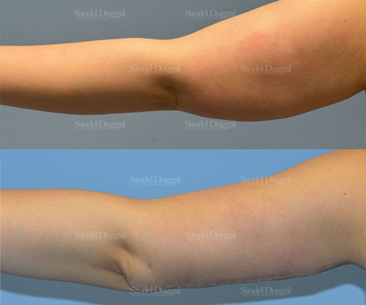 Brachioplasty before and after, case 2129