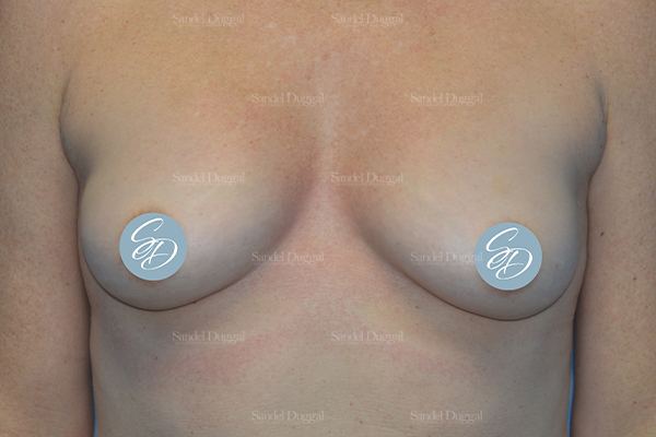 Liposuction — Bra Roll before, case 2492