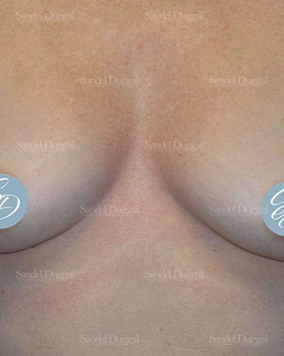 Liposuction — Bra Roll before, case 2492