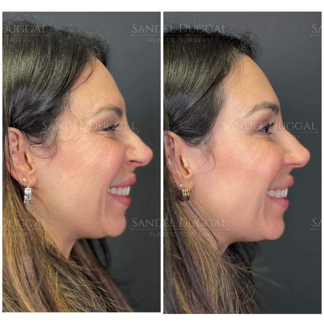 Botox & Fillers before and after, case 6013