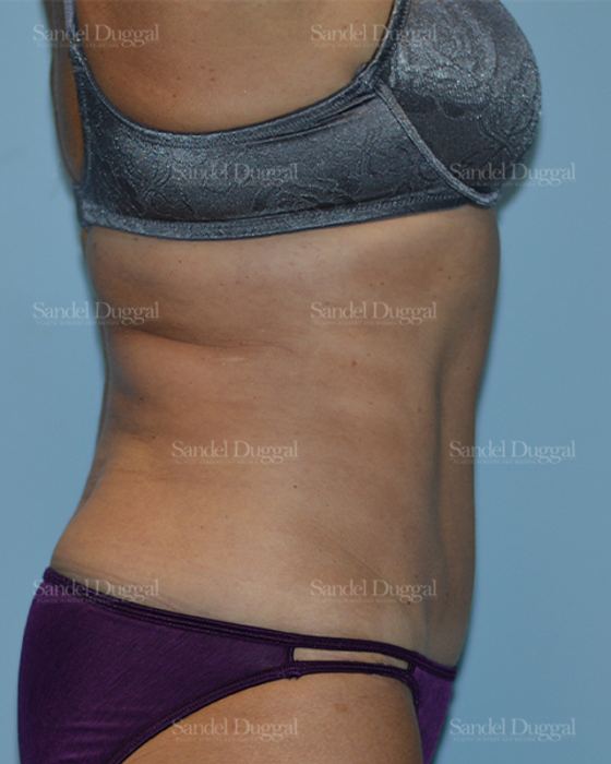 Tummy Tuck after, case 1636