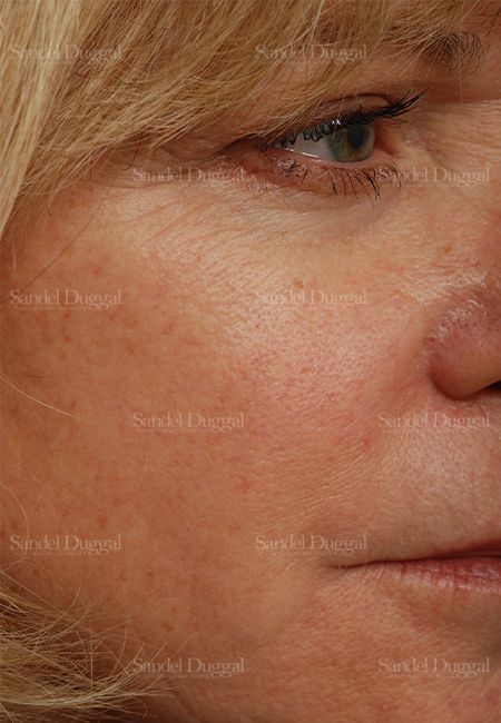 Laser Skin Resurfacing after, case 2947