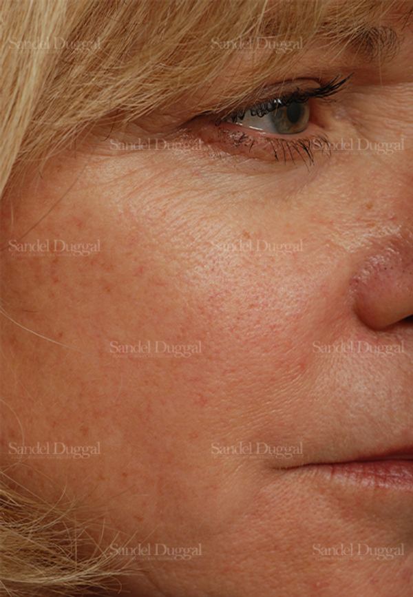 Laser Skin Resurfacing after, case 2947