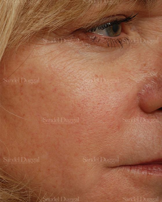 Laser Skin Resurfacing after, case 2947