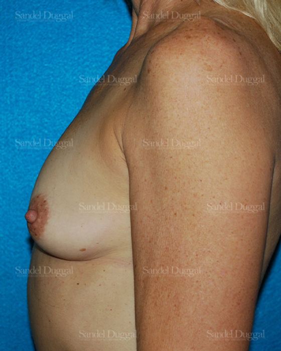 Breast Augmentation before, case 3248