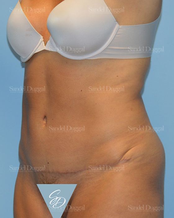 Tummy Tuck after, case 1526