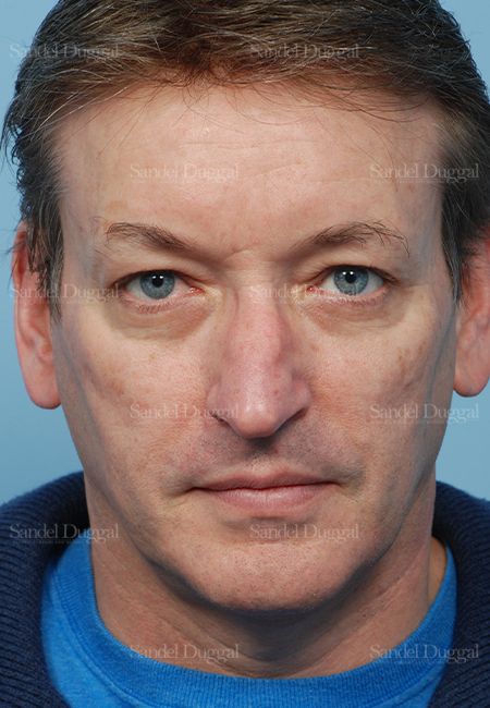 Rhinoplasty before, case 2838