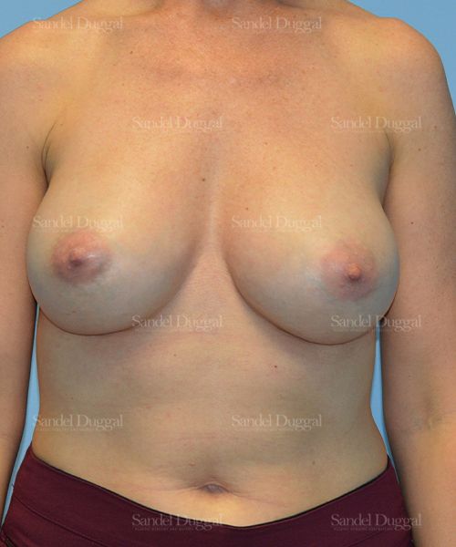 Breast Augmentation after, case 3108
