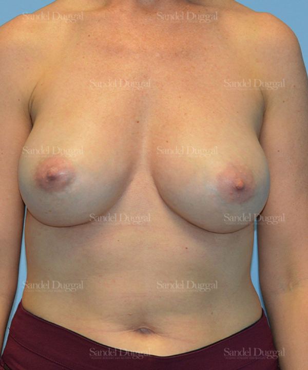 Breast Augmentation after, case 3108