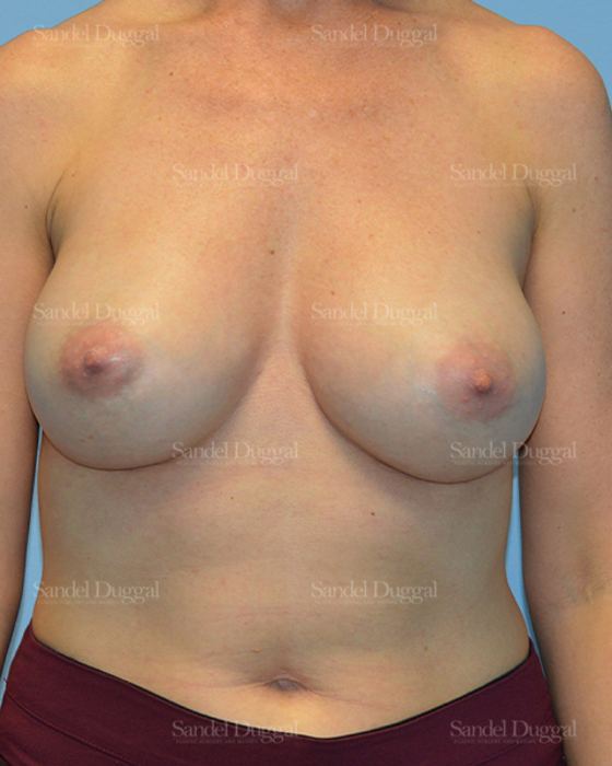 Breast Augmentation after, case 3108