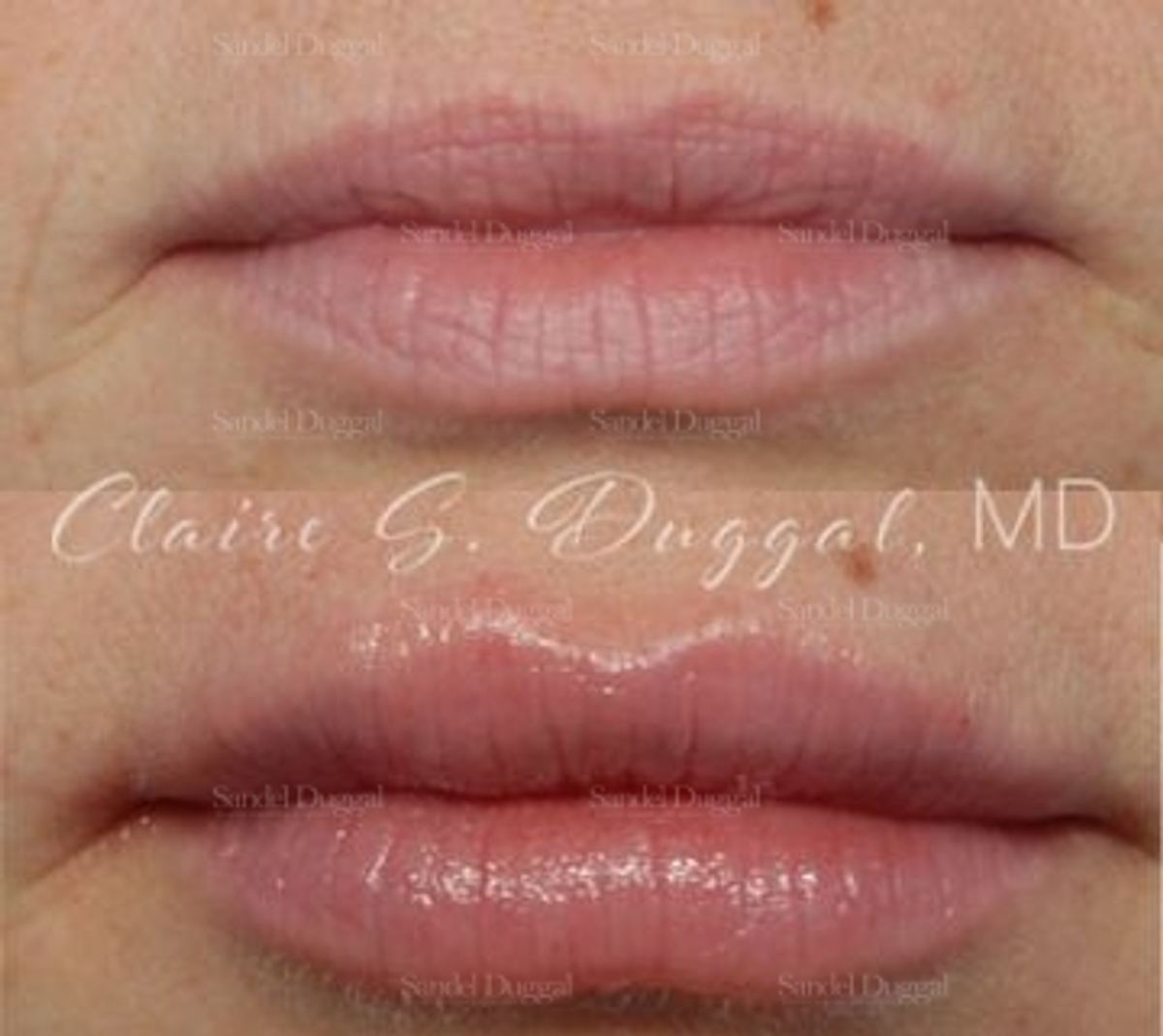 Lip Augmentation / Lip Lift before and after, case 4381