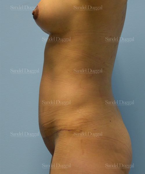 Tummy Tuck after, case 1580