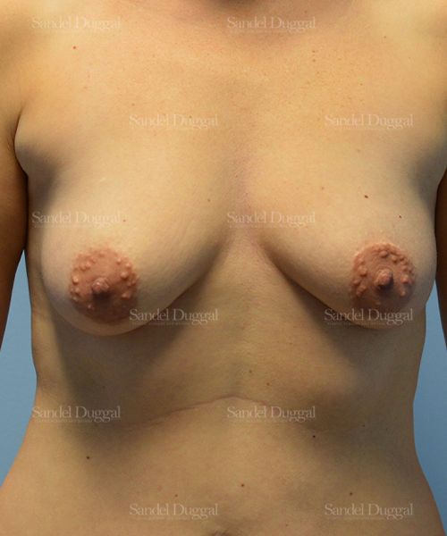 Breast Augmentation with Lift before, case 3456