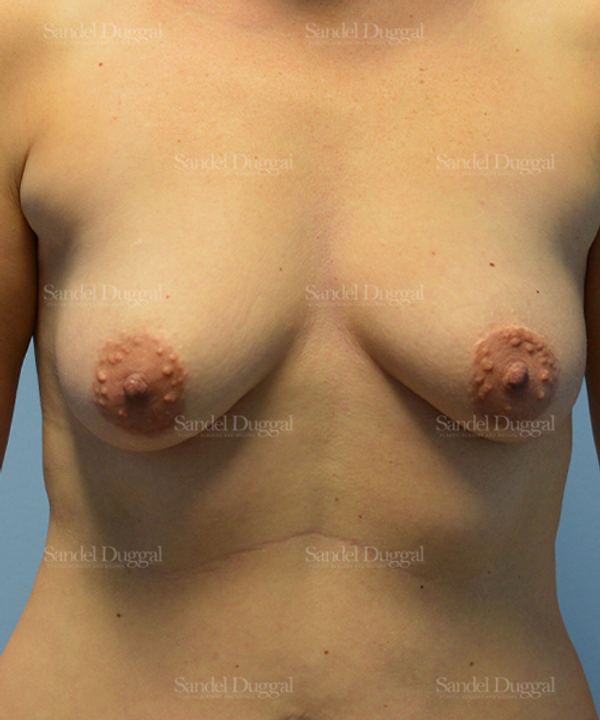 Breast Augmentation with Lift before, case 3456