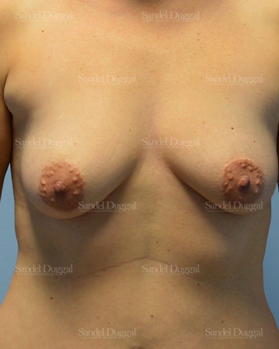 Breast Augmentation with Lift before, case 3456