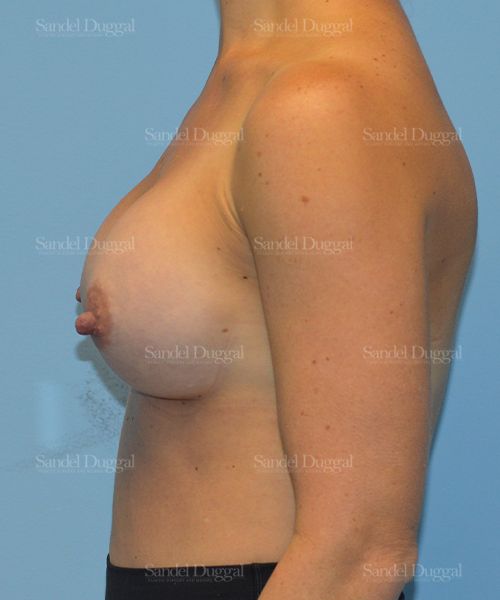 Breast Augmentation after, case 3115