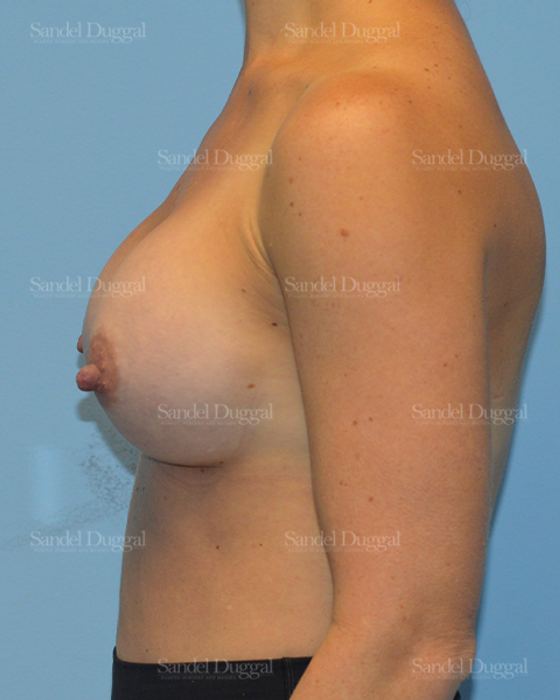 Breast Augmentation after, case 3115