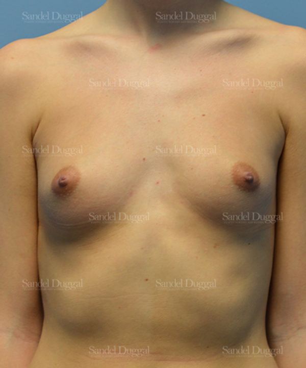 Breast Augmentation before, case 3080