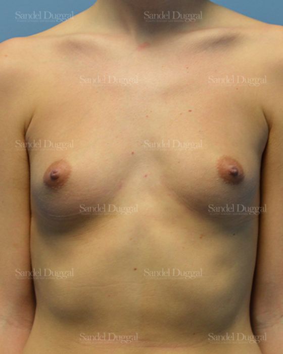 Breast Augmentation before, case 3080