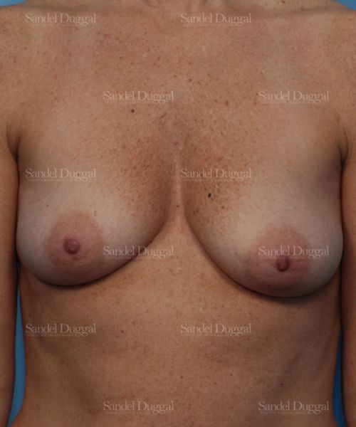 Breast Augmentation with Lift before, case 3435